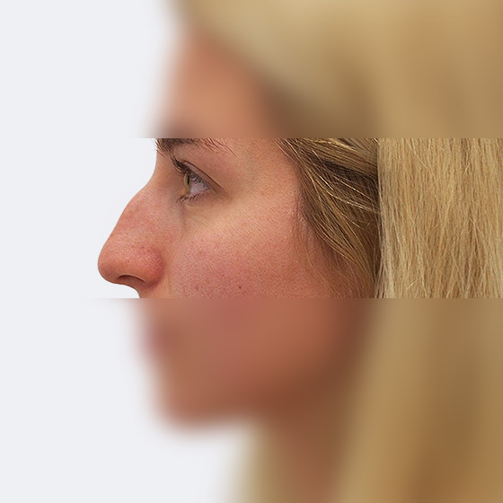 Patientin (26 Jahre) vor und nach plastischen Operation der Nase. Das Foto entstand einen Monat nach dem Eingriff.