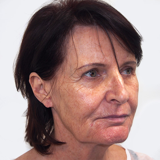 Patientin (65) vor und nach Gesichtsverjüngung MyFaceLift. Die Operation wurde in Lokalanästhesie durchgeführt. Das Foto entstand 3 Wochen nach der Operation.  