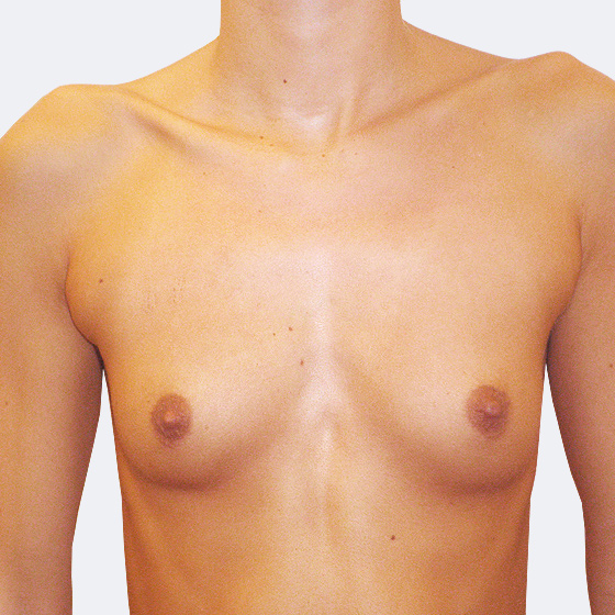 Patientin vor und nach Brustvergrößerung. Es wurden runde Implantate Mentor, Größe 325 Milliliter, hohes Profil verwendet. Eingesetzt wurden durch die Unterbrustfalte unter den Muskel. 