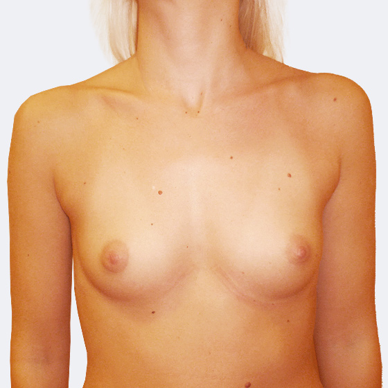 Patientin vor und nach Brustvergrößerung. Es wurden runde Implantate Eurosilicone, Größe 350 Milliliter, hohes Profil verwendet. Eingesetzt wurden durch die Unterbrustfalte unter den Muskel.
