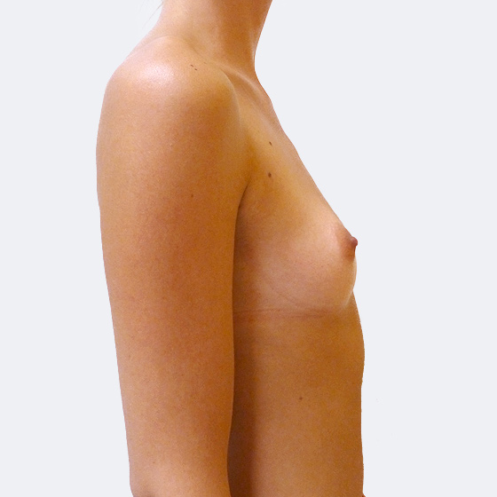 Patientin vor und nach Brustvergrößerung. Es wurden runde Implantate Eurosilicone, Größe 350 Milliliter, hohes Profil verwendet. Eingesetzt wurden durch die Unterbrustfalte unter den Muskel. Das Foto entstand einen Monat nach dem Eingriff.
