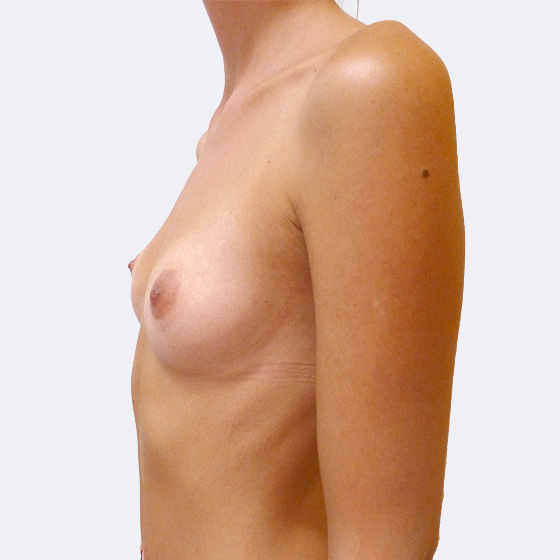 Patientin vor und nach Brustvergrößerung. Es wurden runde Implantate Eurosilicone, Größe 350 Milliliter, hohes Profil verwendet. Eingesetzt wurden durch die Unterbrustfalte unter den Muskel. Das Foto entstand einen Monat nach dem Eingriff.