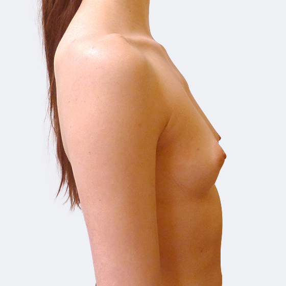 Patientin vor und nach Brustvergrößerung. Es wurden runde Implantate Eurosilicone, Größe 350 Milliliter, hohes Profil verwendet. Eingesetzt wurden durch die Unterbrustfalte unter den Muskel. Das Foto entstand fünf Monate nach der Operation. 