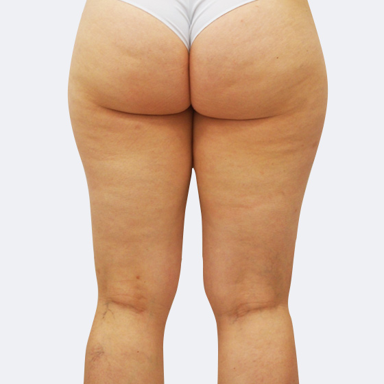 Patientin vor und nach Ultraschall-Fettabsaugung an der Oberschenkelaußenseite unter Lokalanästhesie. Es wurden 600 Milliliter Fett abgesaugt. Das Foto entstand drei Monate nach dem Eingriff.