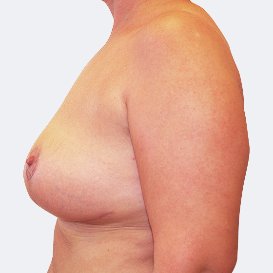 Patientin (37 Jahre) vor und nach Bruststraffung - mittelgroß (bei Brusterschlaffung). Das Foto entstand einen Monat nach dem Eingriff.