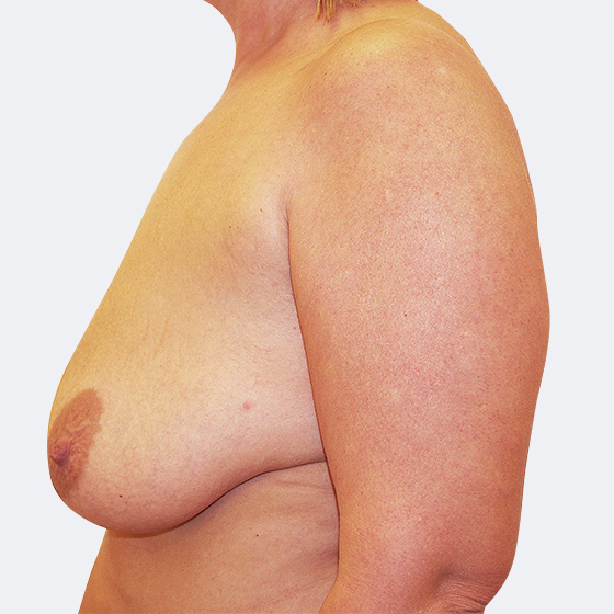 Patientin (37 Jahre) vor und nach Bruststraffung - mittelgroß (bei Brusterschlaffung). Das Foto entstand einen Monat nach dem Eingriff.