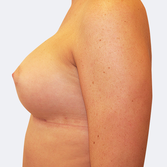 Patientin vor und nach Brustvergrößerung. Es wurden runde Implantate Mentor, Größe 400 Milliliter, hohes Profil verwendet. Eingesetzt wurden durch die Unterbrustfalte unter den Muskel. 