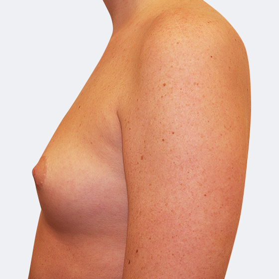 Patientin vor und nach Brustvergrößerung. Es wurden runde Implantate Mentor, Größe 400 Milliliter, hohes Profil verwendet. Eingesetzt wurden durch die Unterbrustfalte unter den Muskel. 
