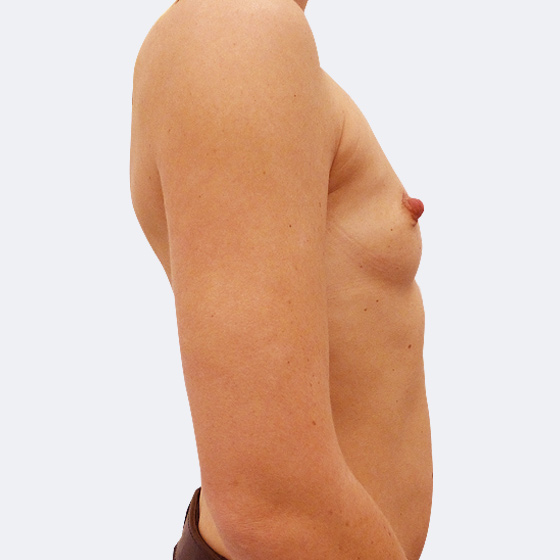 Patientin vor und nach Brustvergrößerung. Es wurden runde Implantate Polytech, Größe 295 Milliliter, hohes Profil verwendet. Eingesetzt wurden durch die Unterbrustfalte unter den Muskel. Das Foto entstand einen Monat nach dem Eingriff. 