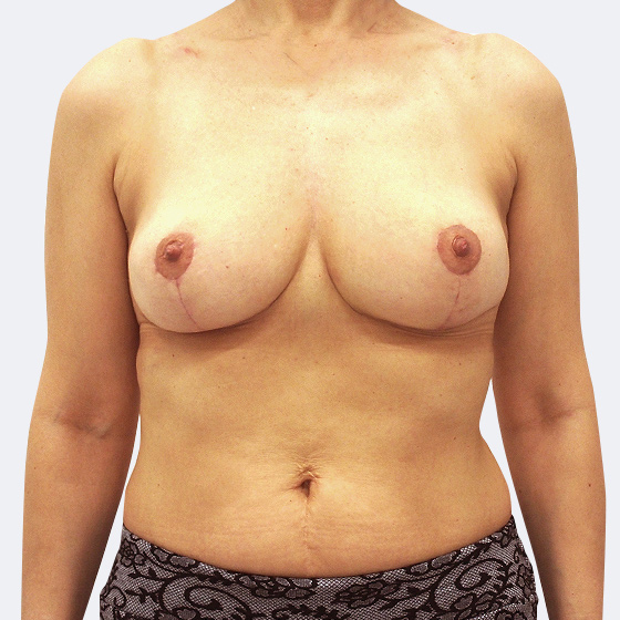 Patientin (52 Jahre) vor und nach Brustverkleinerung inklusive Straffung. Aus der linken Brust wurden 146 Gramm, aus der rechten Brust 149 Gramm Haut und Gewebe entfernt. Das Foto entstand einen Monat nach dem Eingriff. 