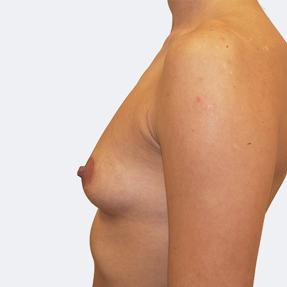 Patientin vor und nach Brustvergrößerung. Es wurden anatomische Implantate Mentor, Größe 330 Milliliter, verwendet. Eingesetzt wurden durch die Unterbrustfalte unter den Muskel.