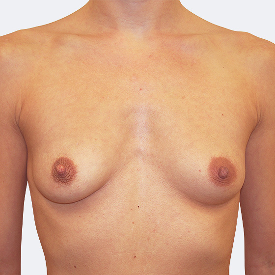 Patientin vor und nach Brustvergrößerung. Es wurden anatomische Implantate Mentor, Größe 330 Milliliter, verwendet. Eingesetzt wurden durch die Unterbrustfalte unter den Muskel.