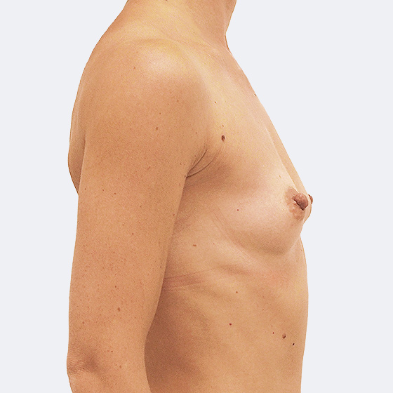 Patientin vor und nach Brustvergrößerung. Es wurden tropfenförmige Implantate Polytech, Größe 315 Milliliter, hohes Profil, verwendet. Eingesetzt wurden durch die Unterbrustfalte unter den Muskel.