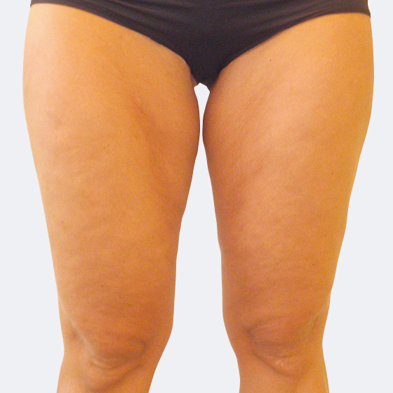 Patientin (40 Jahre) vor und nach Laser-Fettabsaugung an der Oberschenkelinnenseite + Knie unter Lokalanästhesie. Es wurden 600 Milliliter Fett abgesaugt. Das Foto entstand drei Monate nach dem Eingriff.