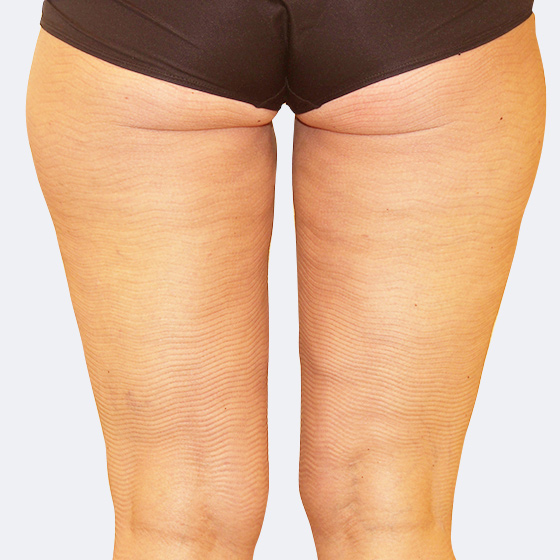 Patientin (40 Jahre) vor und nach Laser-Fettabsaugung an der Oberschenkelinnenseite + Knie unter Lokalanästhesie. Es wurden 600 Milliliter Fett abgesaugt. Das Foto entstand drei Monate nach dem Eingriff.