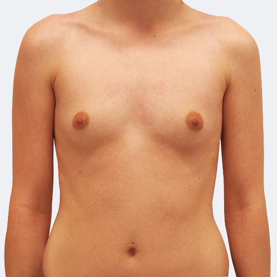 Patientin (26 Jahre) vor und nach Brustvergrößerung. Es wurden runde Implantate Polytech, Größe 320 Milliliter, verwendet. Eingesetzt wurden durch die Unterbrustfalte unter den Muskel. Das Foto entstand einen Monat nach dem Eingriff. 