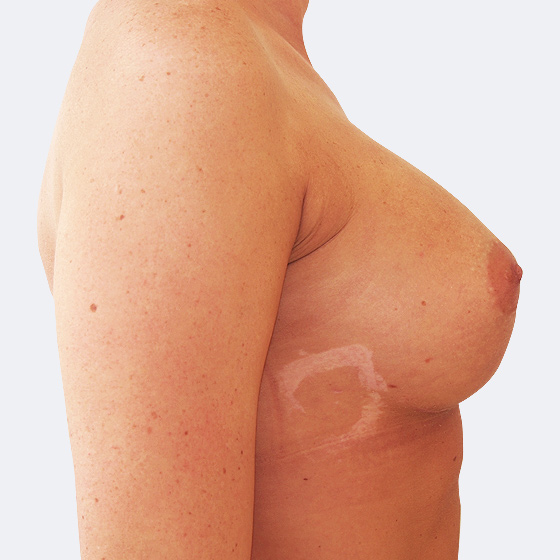 Patientin vor und nach Brustvergrößerung. Es wurden runde Implantate Mentor, Größe 375 Milliliter, mittleres Profil verwendet. Eingesetzt wurden durch die Unterbrustfalte unter den Muskel. Das Foto entstand einen Monat nach dem Eingriff. 