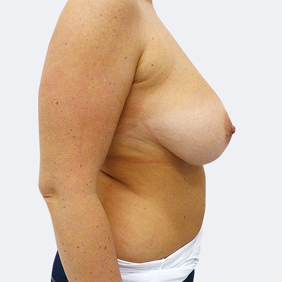 Patientin (43 Jahre) vor und nach Brustverkleinerung inklusive Straffung. Aus der linken Brust wurden 340 Gramm, aus der rechten Brust 260 Gramm Haut und Gewebe entfernt. Das Foto entstand vier Monate nach dem Eingriff. 