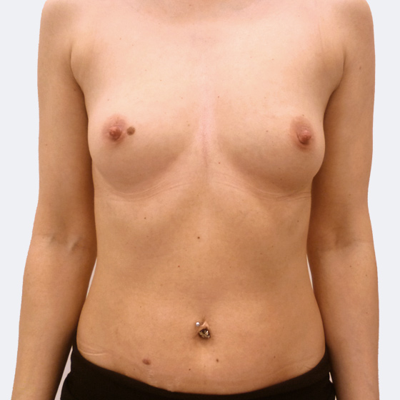 Patientin vor und nach Brustvergrößerung. Es wurden runde Implantate Eurosilicone, Größe 325 Milliliter, hohes Profil, verwendet. Eingesetzt wurden durch die Unterbrustfalte unter den Muskel. 