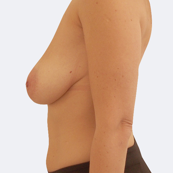Patientin (43 Jahre) vor und nach Bruststraffung - mittelgroß (bei Brusterschlaffung). Das Foto entstand zwei Monate nach dem Eingriff.