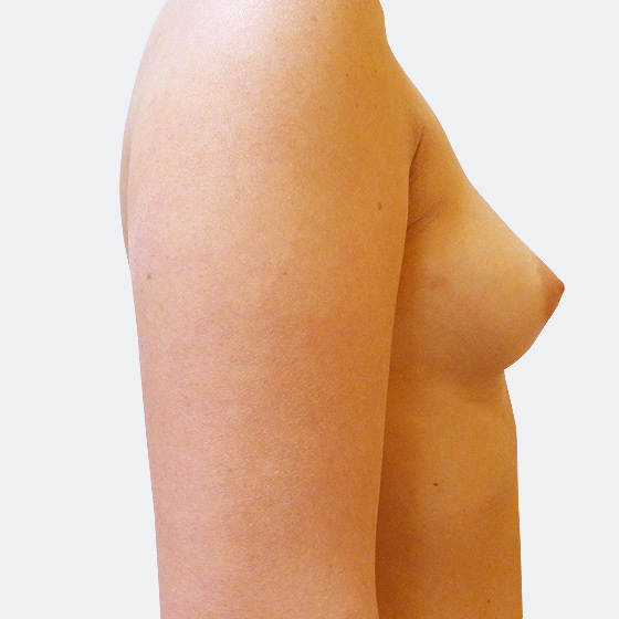 Patientin vor und nach Brustvergrößerung. Es wurden runde Implantate Polytech, Größe 275 Milliliter, hohes Profil verwendet. Eingesetzt wurden durch die Unterbrustfalte unter den Muskel. Das Foto entstand vier Monate nach dem Eingriff. 