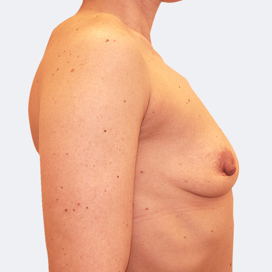 Patientin vor und nach Brustvergrößerung. Es wurden Implantate Mentor, Größe 275 Milliliter, mittleres Profil verwendet. Eingesetzt wurden durch die Unterbrustfalte unter den Muskel. Das Foto entstand einen Monat nach dem Eingriff. 