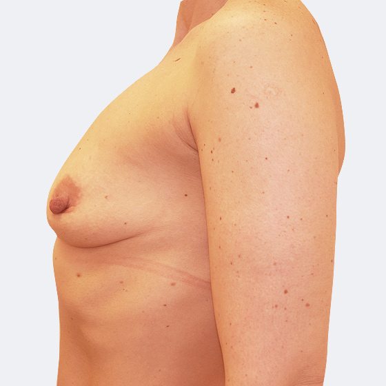 Patientin vor und nach Brustvergrößerung. Es wurden Implantate Mentor, Größe 275 Milliliter, mittleres Profil verwendet. Eingesetzt wurden durch die Unterbrustfalte unter den Muskel. Das Foto entstand einen Monat nach dem Eingriff. 