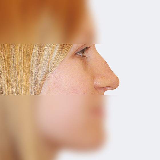 Patientin (22 Jahre) vor und nach plastischen Operation der Nase. Das Foto entstand vier Monate nach dem Eingriff.