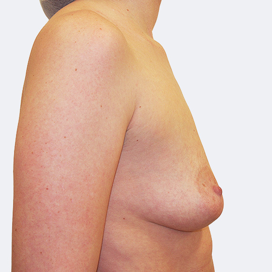 Patientin vor und nach Brustvergrößerung. Es wurden anatomische Implantate Mentor, Größe 375 Milliliter, hohes Profil, verwendet. Eingesetzt wurden durch die Unterbrustfalte unter den Muskel.