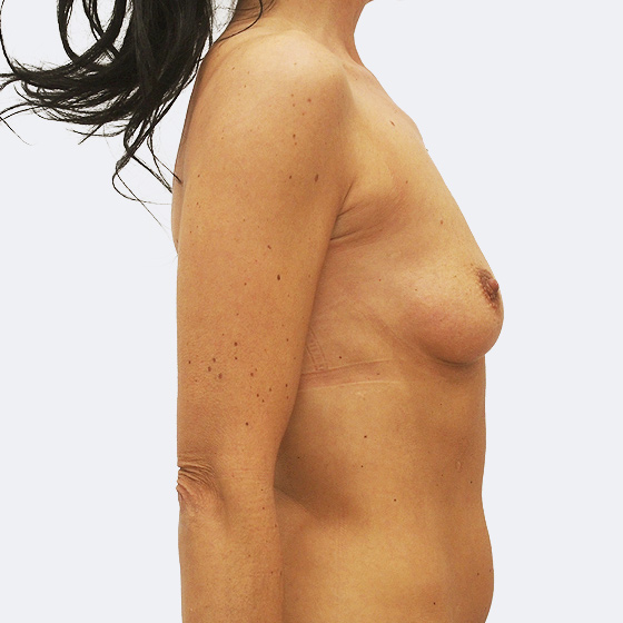 Patientin vor und nach Brustvergrößerung. Es wurden runde Implantate Eurosilicone, Größe 400 Milliliter, hohes Profil, verwendet. Eingesetzt wurden durch die Unterbrustfalte unter den Muskel.