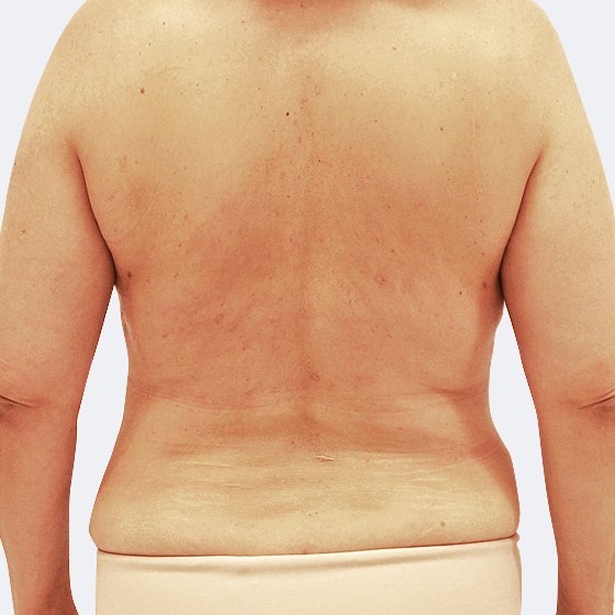 Patientin vor und nach Ultraschall-Fettabsaugung am Rücken unter Lokalanästhesie. Es wurden 1100 Milliliter Fett abgesaugt. Das Foto entstand drei Monate nach dem Eingriff.