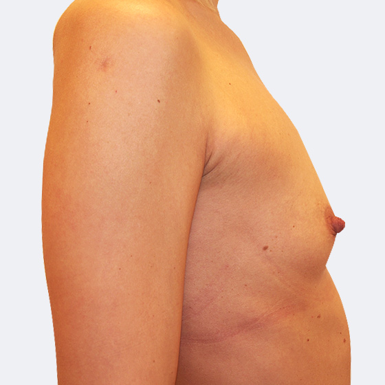 Patientin vor und nach Brustvergrößerung. Es wurden anatomische Implantate Mentor, Größe 330 Milliliter, verwendet. Eingesetzt wurden durch die Unterbrustfalte unter den Muskel. Das Foto entstand einen Monat nach dem Eingriff. 