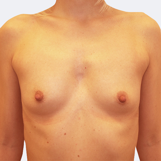 Patientin vor und nach Brustvergrößerung. Es wurden anatomische Implantate Mentor, Größe 330 Milliliter, verwendet. Eingesetzt wurden durch die Unterbrustfalte unter den Muskel. Das Foto entstand einen Monat nach dem Eingriff. 