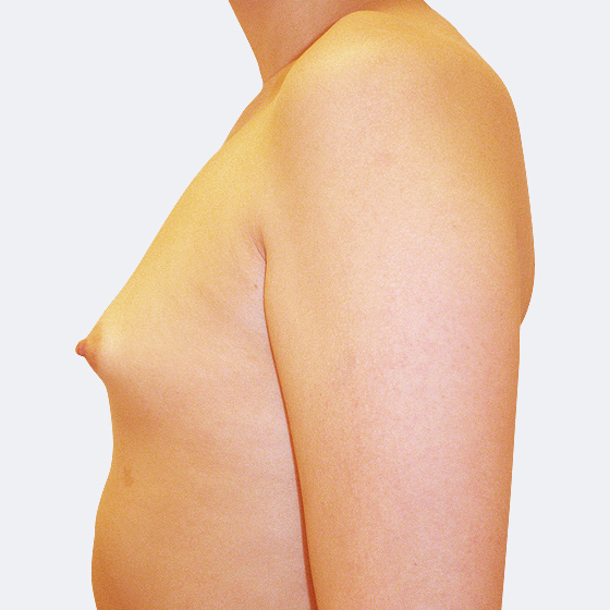 Patientin vor und nach Brustvergrößerung. Es wurden runde Implantate Mentor, Größe 500 Milliliter, hohes Profil verwendet. Eingesetzt wurden durch die Unterbrustfalte unter den Muskel. 