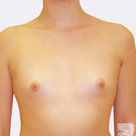 Patientin vor und nach Brustvergrößerung. Es wurden runde Implantate Mentor, Größe 500 Milliliter, hohes Profil verwendet. Eingesetzt wurden durch die Unterbrustfalte unter den Muskel. 