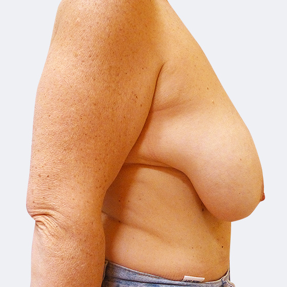 Patientin vor und nach Brustverkleinerung inklusive Straffung, 50 Jahre. Aus jeder Brust wurden 460 Gramm Haut und Gewebe entfernt. Das Foto entstand vier Monate nach der Operation. 