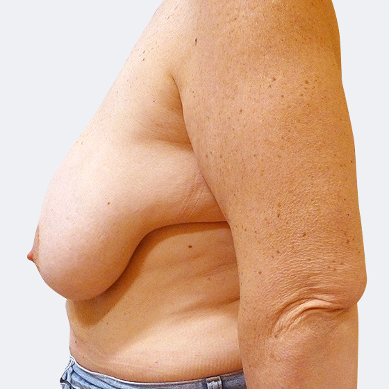 Patientin vor und nach Brustverkleinerung inklusive Straffung, 50 Jahre. Aus jeder Brust wurden 460 Gramm Haut und Gewebe entfernt. Das Foto entstand vier Monate nach der Operation. 