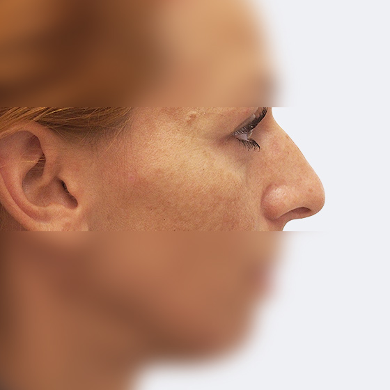 Patientin (33 Jahre) vor und nach plastischen Operation der Nase. Das Foto entstand drei Monate nach dem Eingriff.