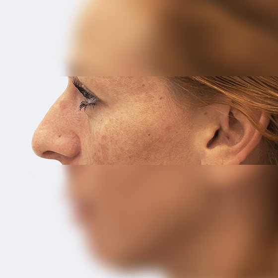 Patientin (33 Jahre) vor und nach plastischen Operation der Nase. Das Foto entstand drei Monate nach dem Eingriff.