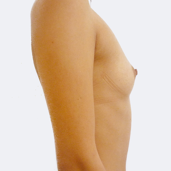 Patientin vor und nach Brustvergrößerung. Es wurden runde Implantate Polytech, Größe 315 Milliliter, hohes Profil, verwendet. Eingesetzt wurden durch die Unterbrustfalte unter den Muskel. 