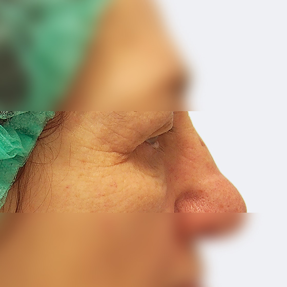 Patientin vor und nach plastischen Operation der Ober- und Unterlider unter Lokalanästhesie. Das Foto entstand einen Monat nach dem Eingriff.