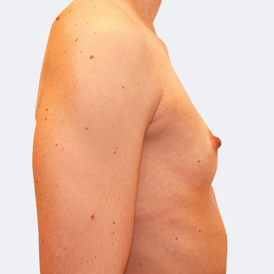 Patientin vor und nach Brustvergrößerung. Es wurden runde Implantate Mentor, Größe 275 Milliliter, mittleres Profil verwendet. Eingesetzt wurden durch die Unterbrustfalte unter den Muskel. Das Foto entstand einen Monat nach dem Eingriff. 
