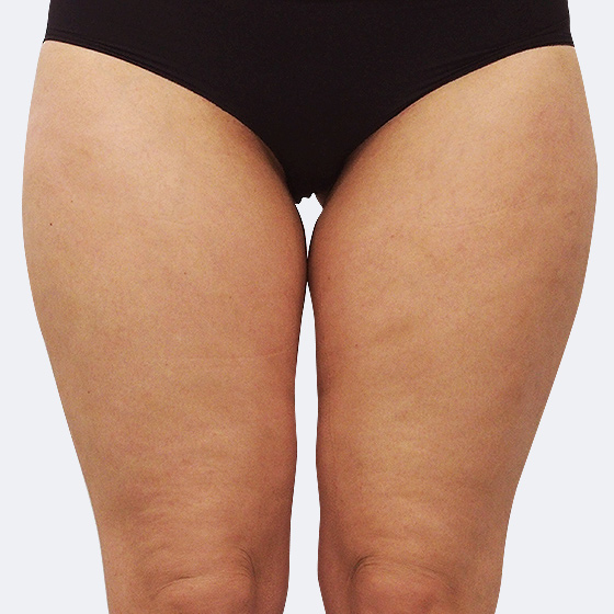 Patientin vor und nach Ultraschall-Fettabsaugung an der Oberschenkelaußenseite unter Lokalanästhesie. Es wurden 1100 Milliliter Fett abgesaugt. Das Foto entstand drei Monate nach dem Eingriff.