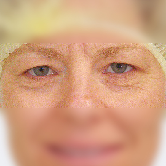 Patientin vor und nach plastischen Operation der Oberlider, 41 Jahre. Das Foto entstand drei Monate nach dem Eingriff.