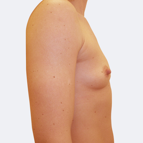 Patientin vor und nach Brustvergrößerung. Es wurden runde Implantate Mentor, Größe 300 Milliliter, mittleres Profil verwendet. Eingesetzt wurden durch die Unterbrustfalte unter den Muskel. Das Foto entstand einen Monat nach dem Eingriff. 