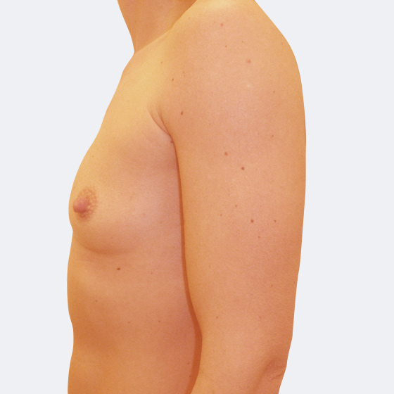 Patientin vor und nach Brustvergrößerung. Es wurden runde Implantate Mentor, Größe 300 Milliliter, mittleres Profil verwendet. Eingesetzt wurden durch die Unterbrustfalte unter den Muskel. Das Foto entstand einen Monat nach dem Eingriff. 