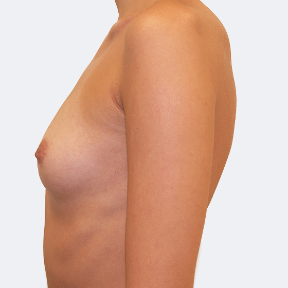 Patientin vor und nach Brustvergrößerung. Es wurden runde Implantate Mentor, Größe 350 Milliliter, verwendet. Eingesetzt wurden durch die Unterbrustfalte unter den Muskel. Das Foto entstand einen Monat nach dem Eingriff. 
