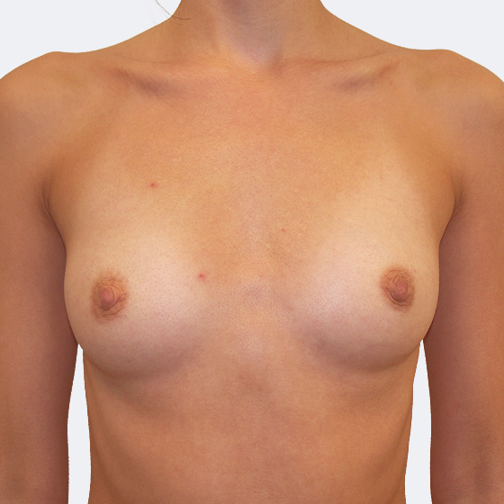 Patientin vor und nach Brustvergrößerung. Es wurden runde Implantate Mentor, Größe 350 Milliliter, verwendet. Eingesetzt wurden durch die Unterbrustfalte unter den Muskel. Das Foto entstand einen Monat nach dem Eingriff. 