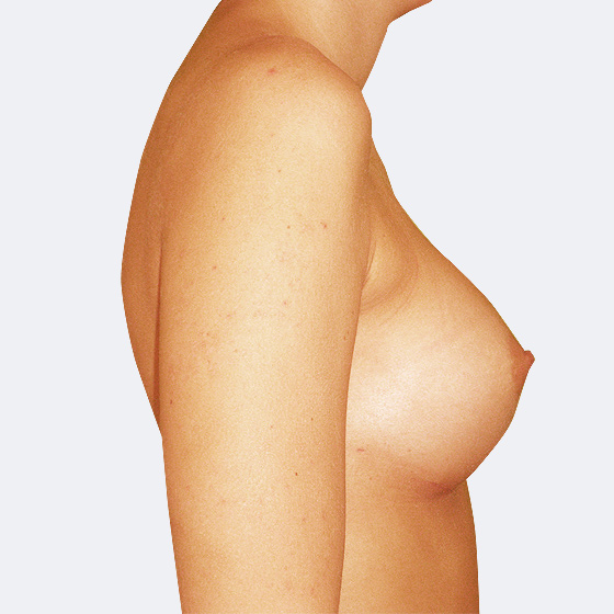Patientin vor und nach Brustvergrößerung. Es wurden runde Implantate Mentor, Größe 325 Milliliter, verwendet. Eingesetzt wurden durch die Unterbrustfalte unter den Muskel. Das Foto entstand einen Monat nach dem Eingriff.