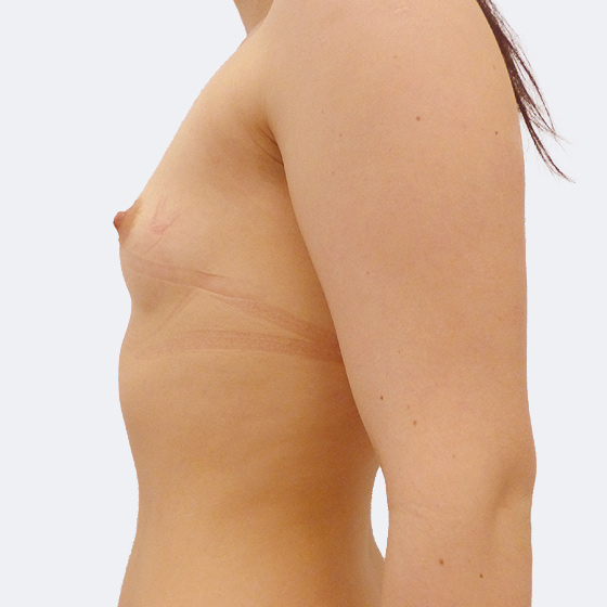 Patientin vor und nach Brustvergrößerung. Es wurden runde Implantate Mentor, Größe 350 Milliliter, verwendet. Eingesetzt wurden durch die Unterbrustfalte unter den Muskel. 
